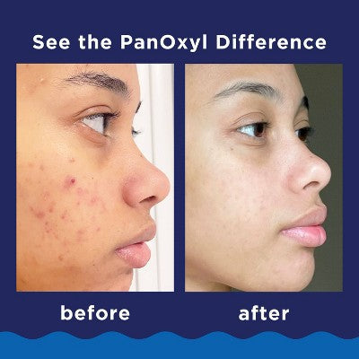 PanOxyl 10% Benzoyl Peroxide Acne Foaming Wash 5.5oz - Missing Box
