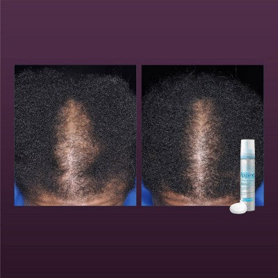 Women's Rogaine 5% Minoxidil Foam for Hair Thinning and Loss 2.11oz - Imperfect Box