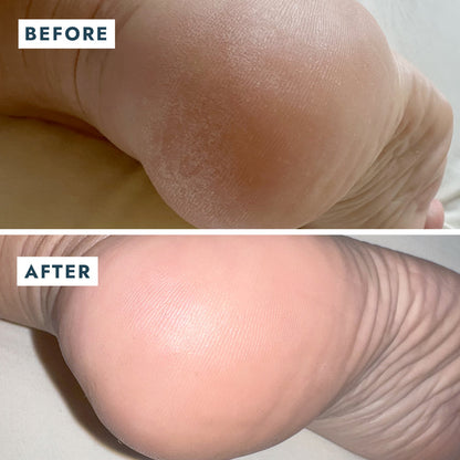 VOESH Heel Repair Duo - Repair Balm + Heel Socks
